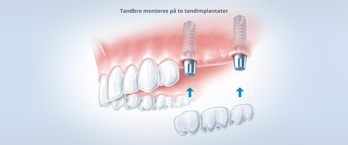 Tandimplantater som erstatning for flere manglende tænder